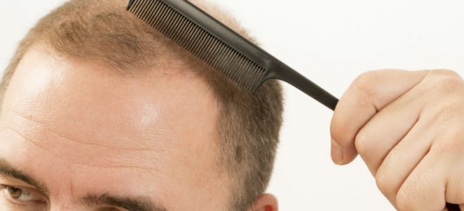 You Have Finally Decided to do Something About your Hair Loss in Philadelphia, Pennsylvania