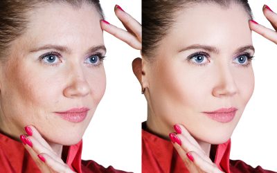 Smooth Fine Lines with PDO Thread Philadelphia PA and Experience a Non Surgical Facelift