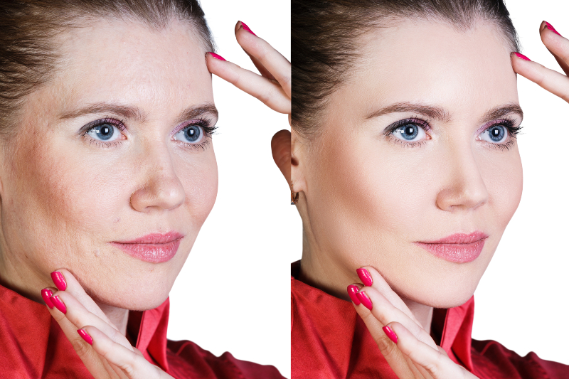 Smooth Fine Lines with PDO Thread Philadelphia PA and Experience a Non Surgical Facelift