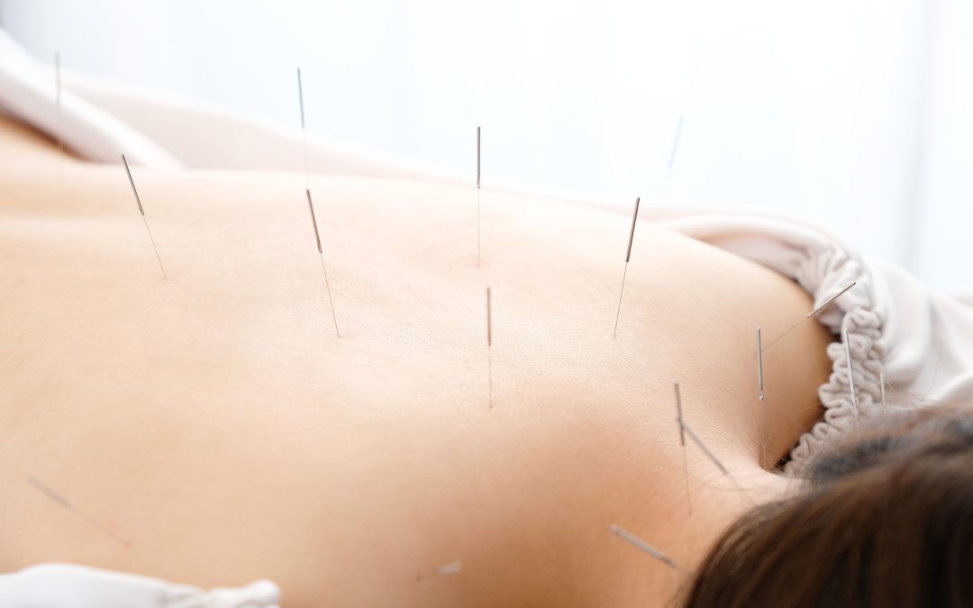 Experience natural relief with acupuncture for depression in Sherman Oaks CA and improve your well-being